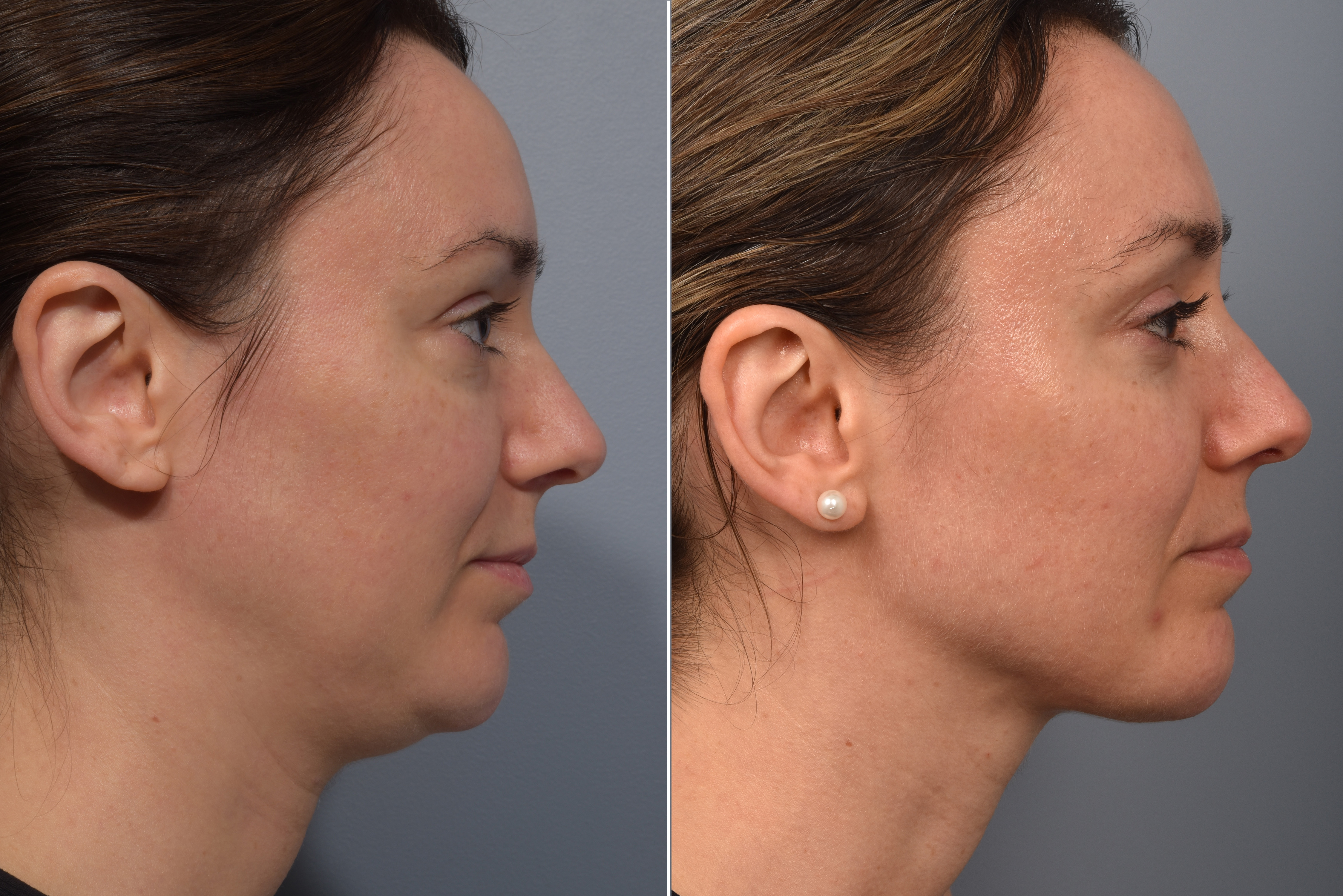 Neck Lift Before & After Gallery - Patient 422422 - Image 7