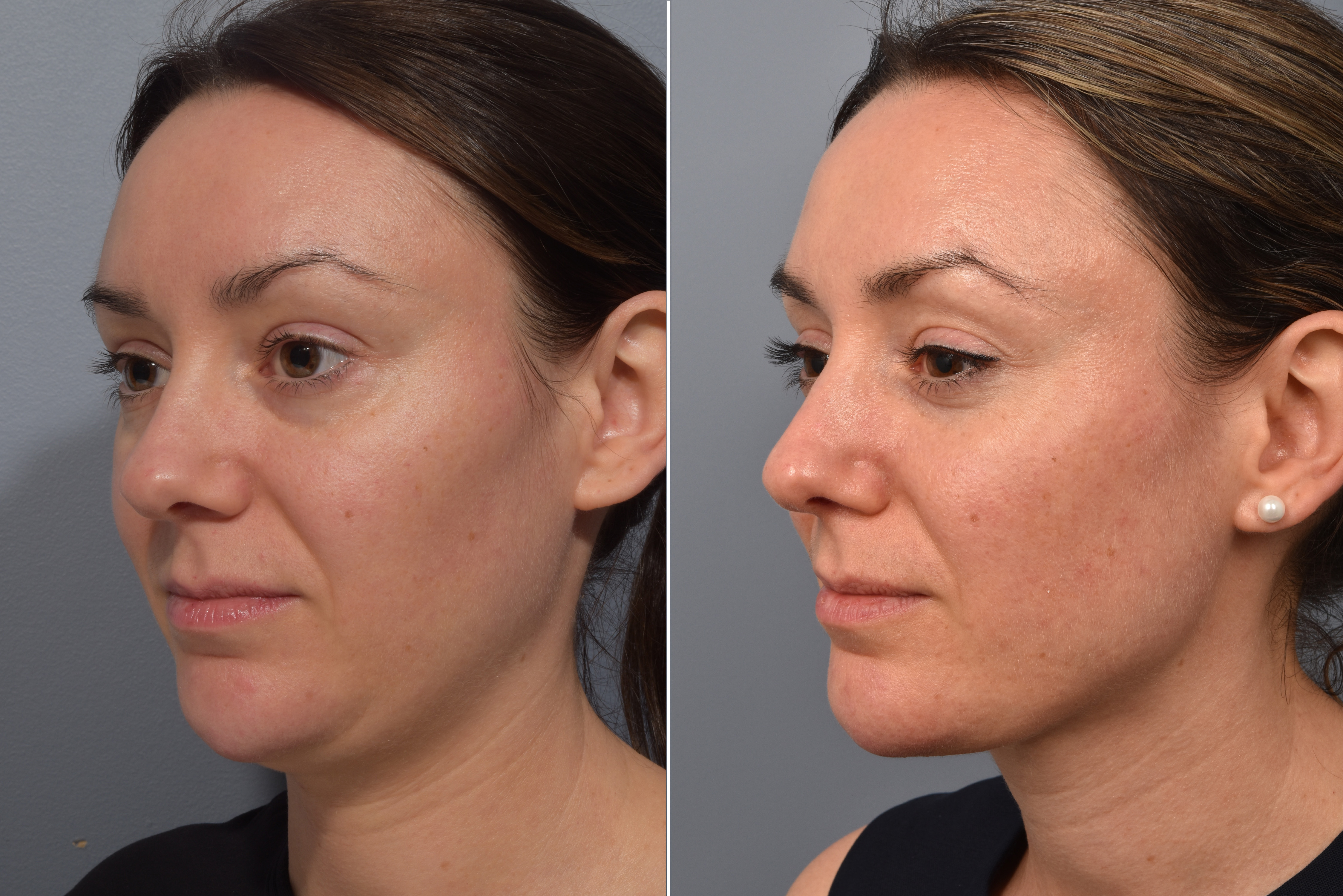 Neck Lift Before & After Gallery - Patient 422422 - Image 9