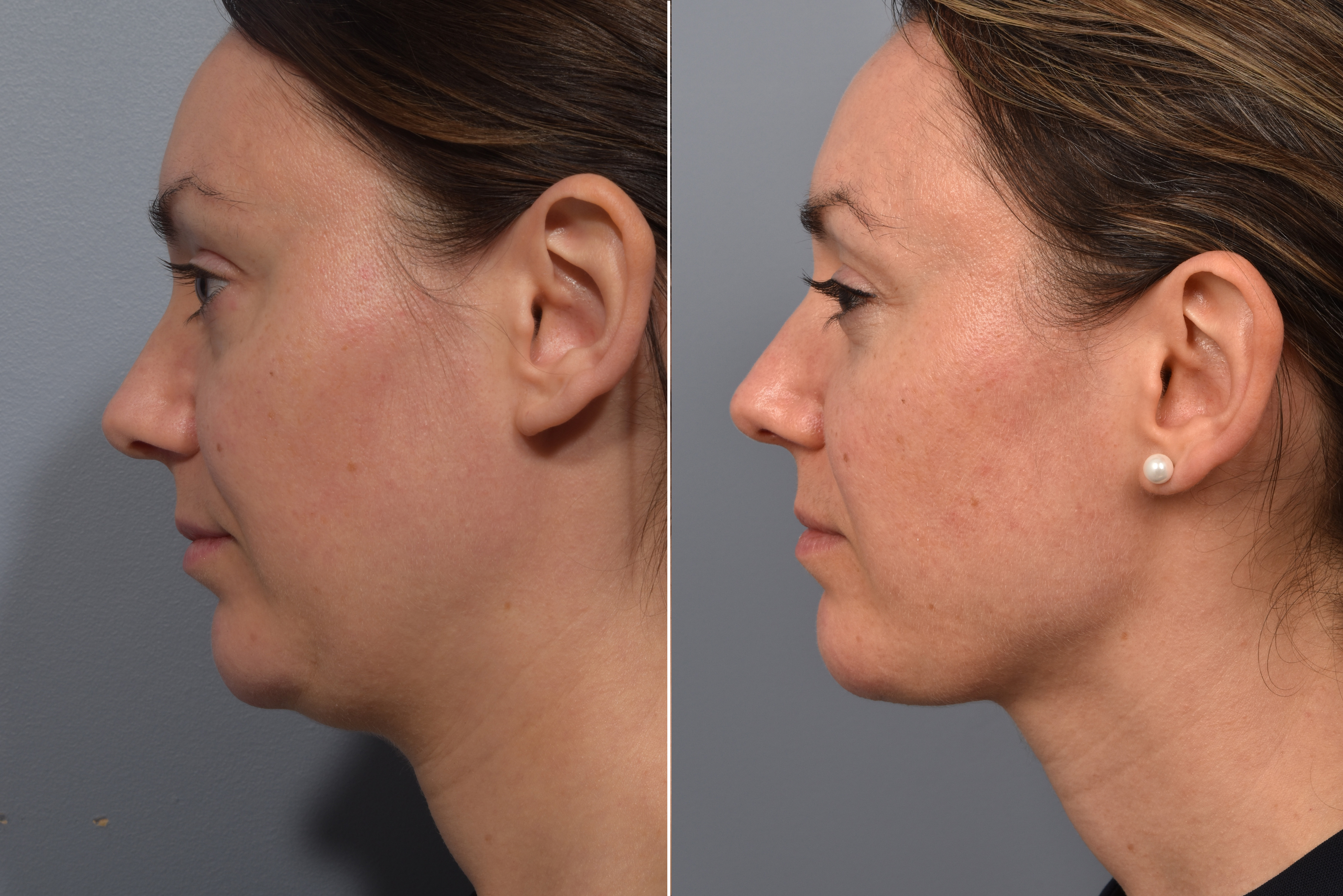 Neck Lift Before & After Gallery - Patient 422422 - Image 10