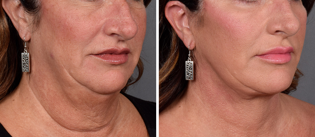 Neck Lift Before & After Gallery - Patient 837658 - Image 1