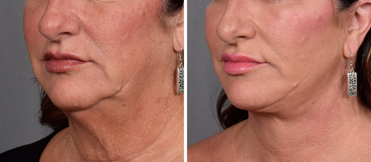 Neck Lift Before & After Gallery - Patient 837658 - Image 3