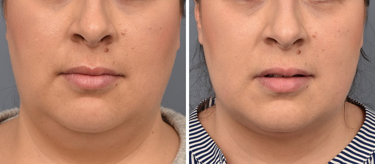 Neck Lift Before & After Gallery - Patient 328421 - Image 3
