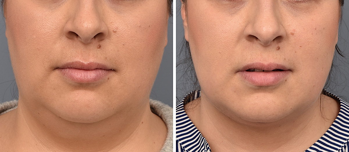 Neck Lift Before & After Gallery - Patient 328421 - Image 3