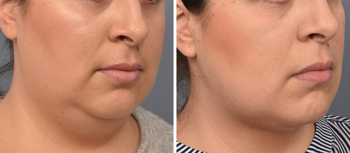 Neck Lift Before & After Gallery - Patient 328421 - Image 1