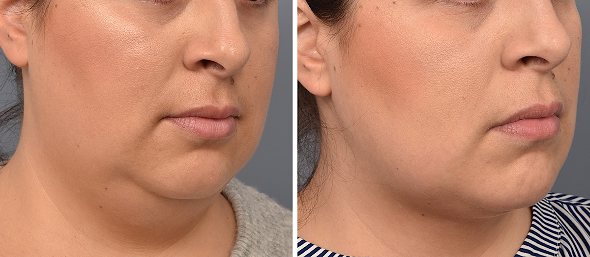 Neck Lift Before & After Gallery - Patient 328421 - Image 1