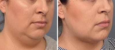 Neck Lift Before & After Gallery - Patient 328421 - Image 1