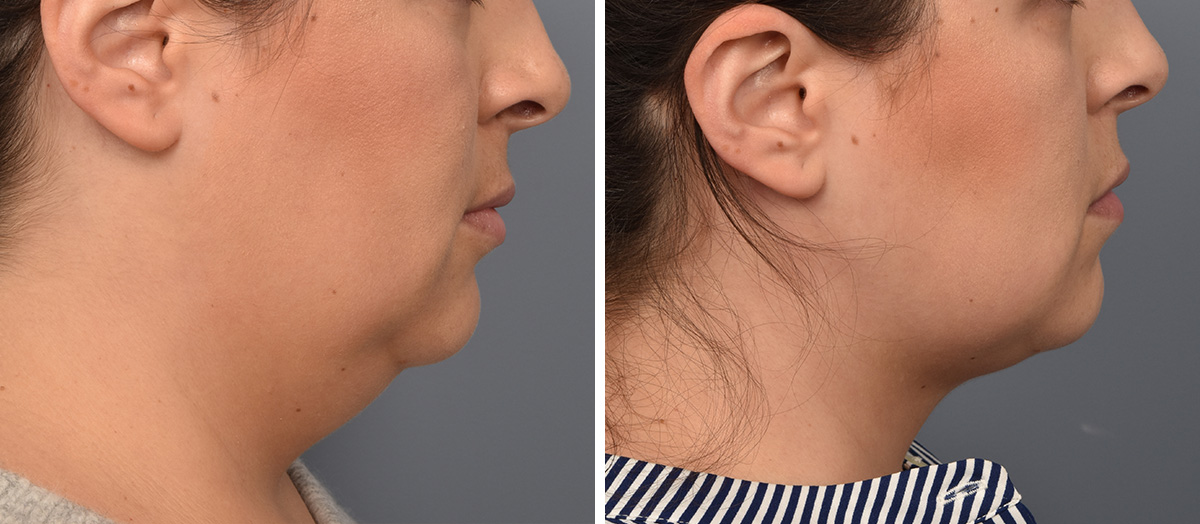 Neck Lift Before & After Gallery - Patient 328421 - Image 2