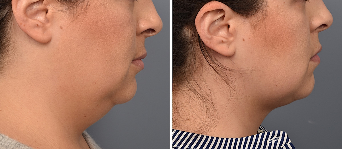 Neck Lift Before & After Gallery - Patient 328421 - Image 2