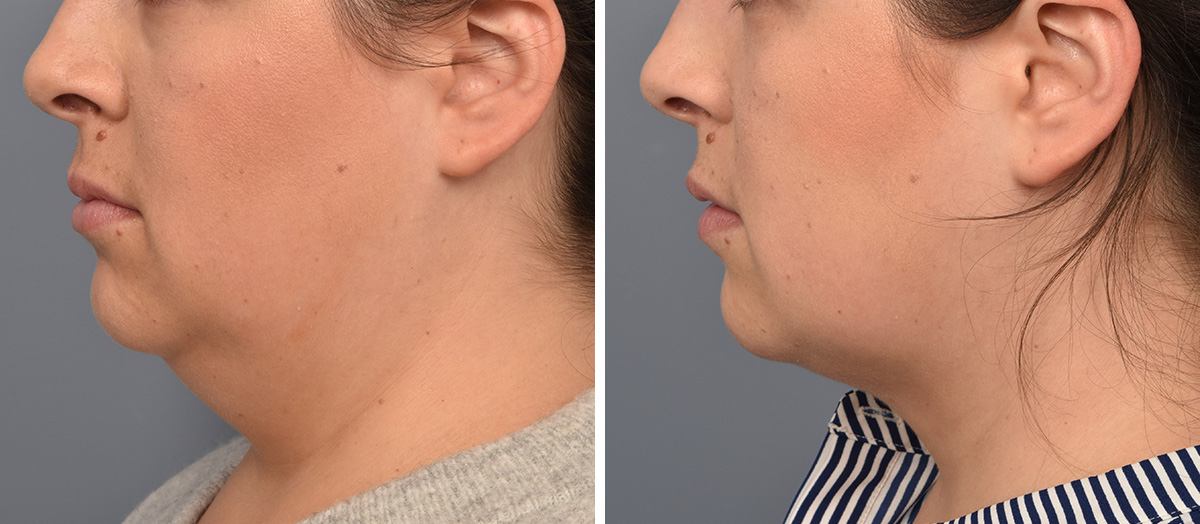 Neck Lift Before & After Gallery - Patient 328421 - Image 4