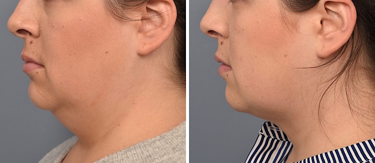 Neck Lift Before & After Gallery - Patient 328421 - Image 4