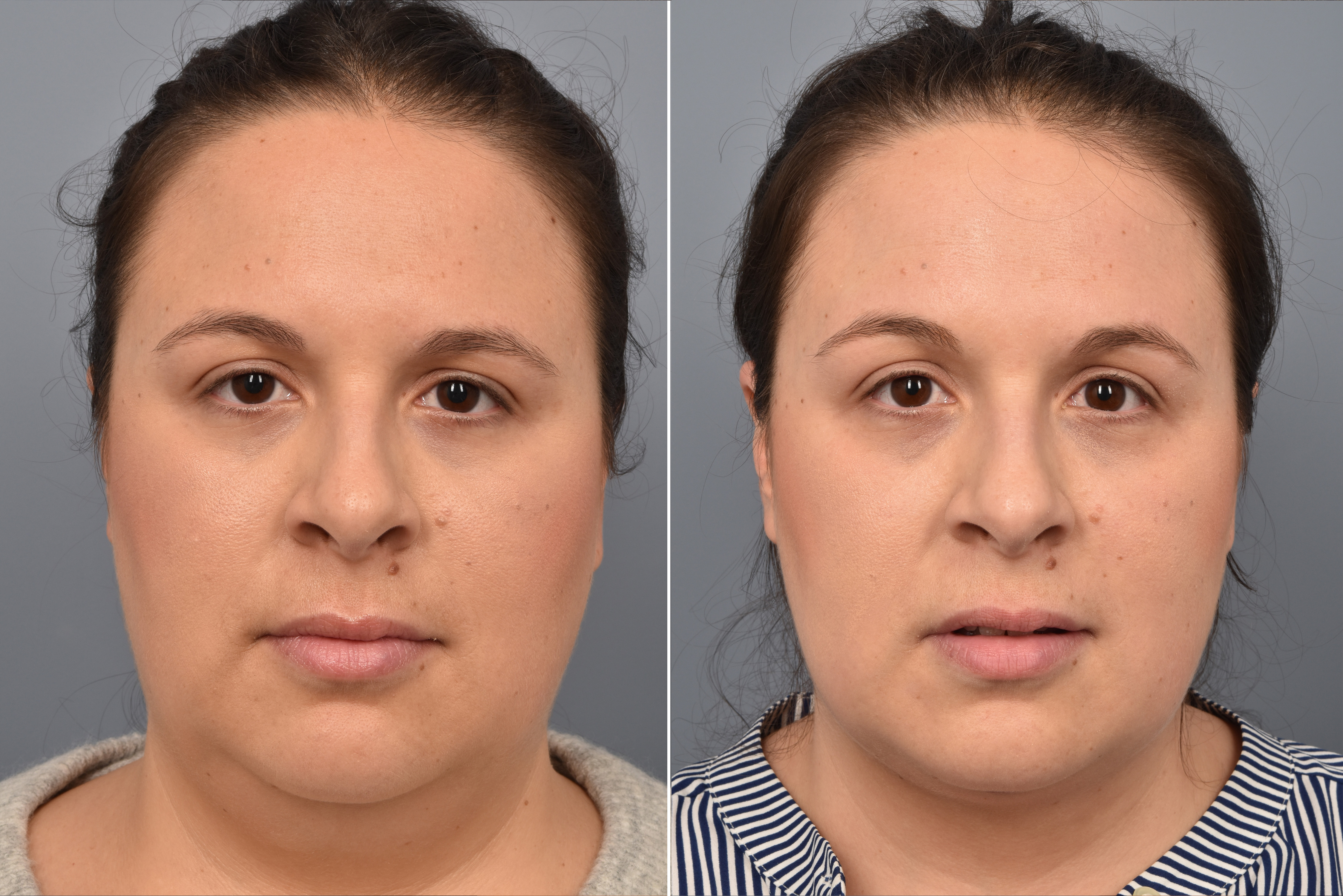 Neck Lift Before & After Gallery - Patient 328421 - Image 7