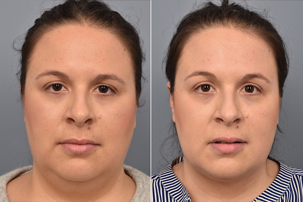 Neck Lift Before & After Gallery - Patient 328421 - Image 7