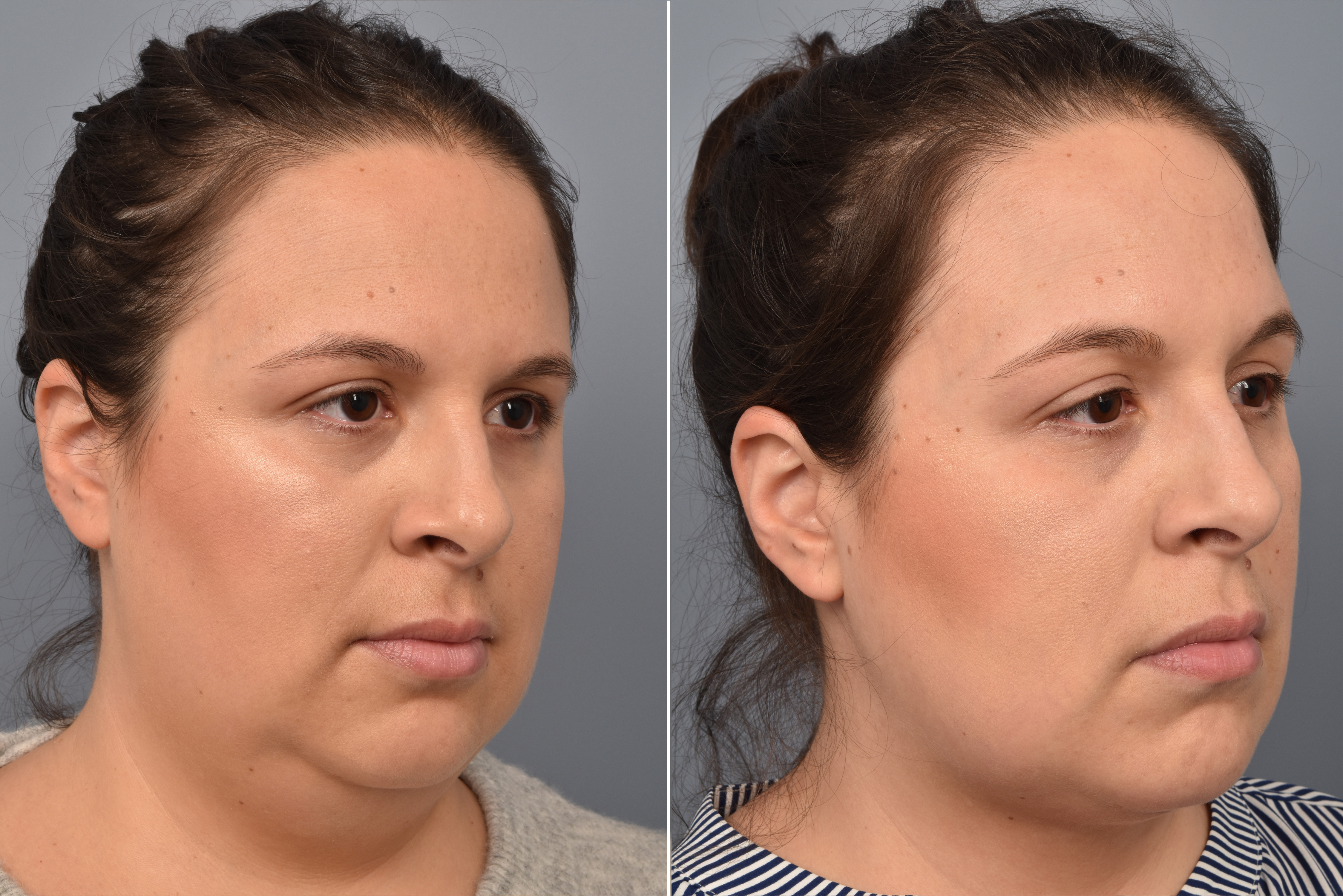 Neck Lift Before & After Gallery - Patient 328421 - Image 5
