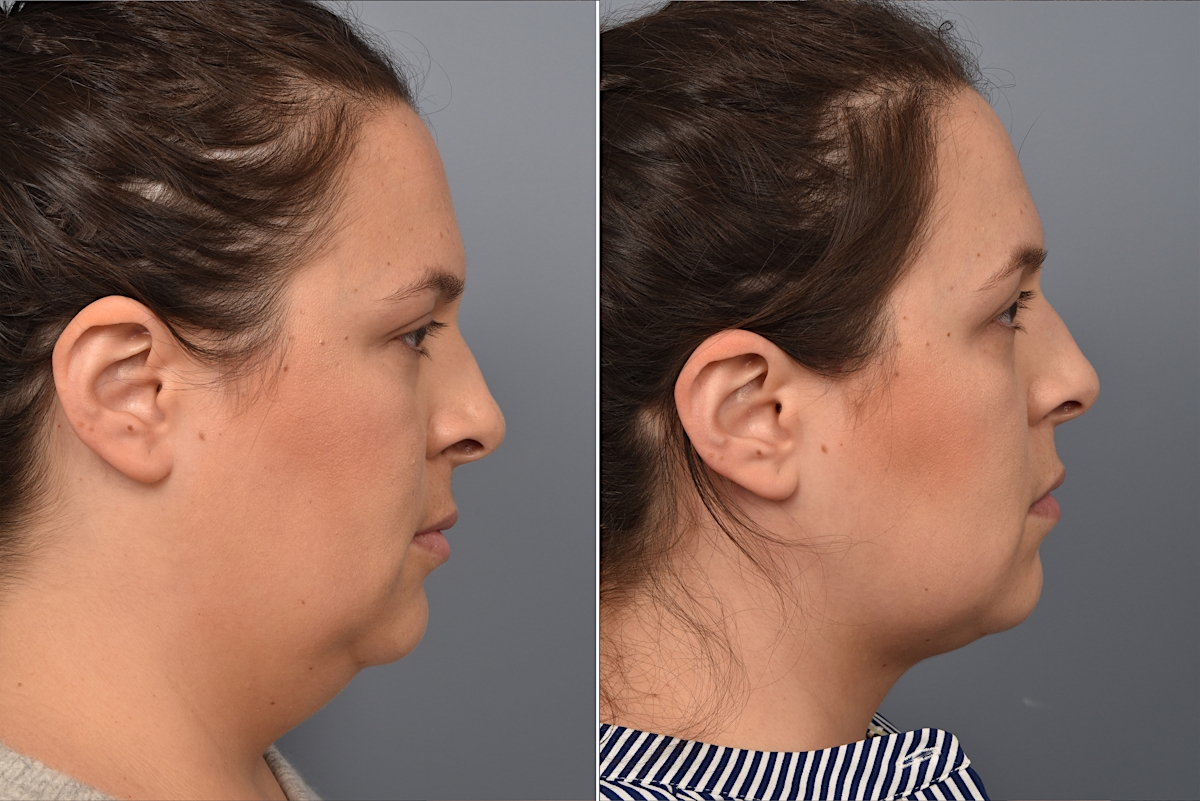 Neck Lift Before & After Gallery - Patient 328421 - Image 6