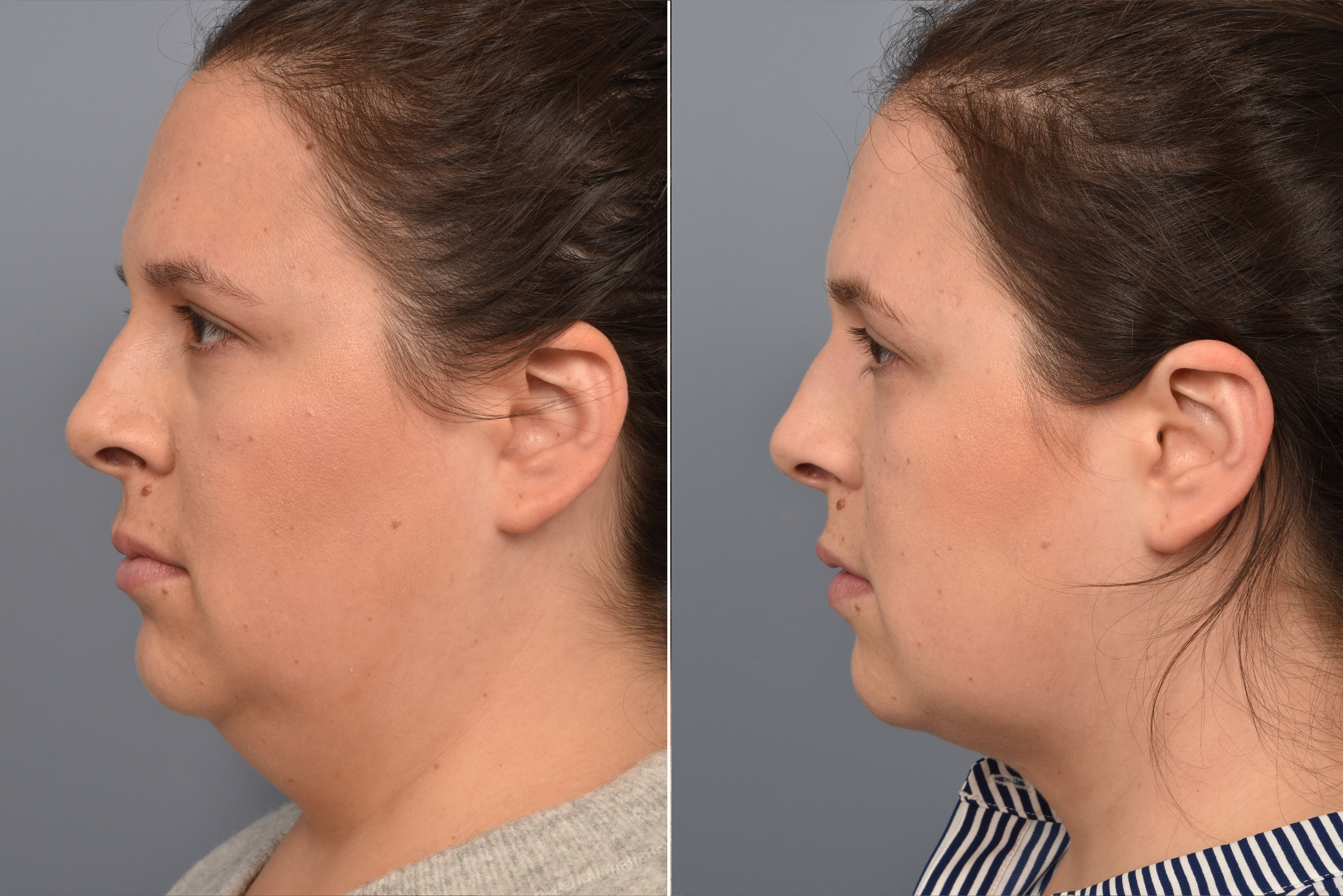 Neck Lift Before & After Gallery - Patient 328421 - Image 8