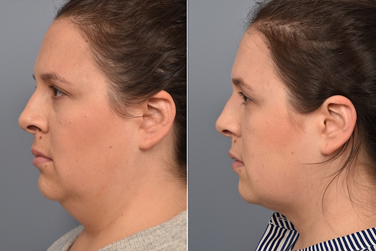 Neck Lift Before & After Gallery - Patient 328421 - Image 8