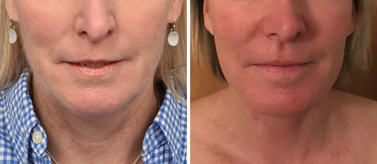 Neck Lift Before & After Gallery - Patient 125015 - Image 3