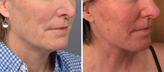 Neck Lift Before & After Gallery - Patient 125015 - Image 1