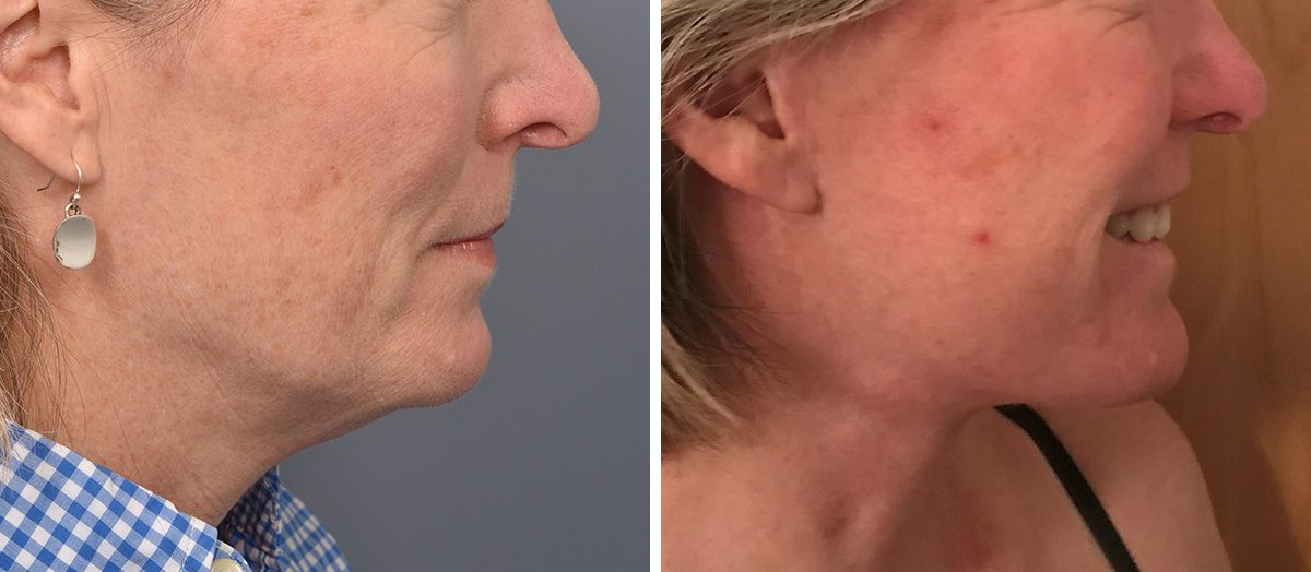 Neck Lift Before & After Gallery - Patient 125015 - Image 2