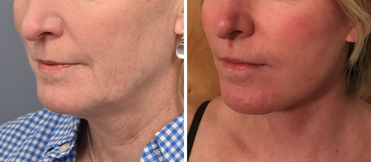 Neck Lift Before & After Gallery - Patient 125015 - Image 4