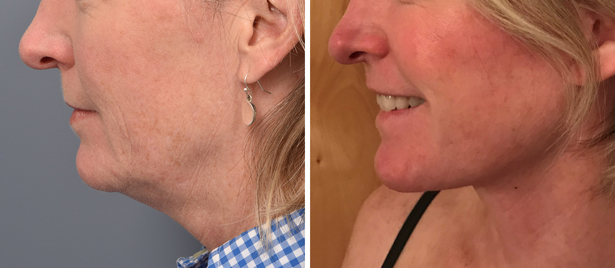 Neck Lift Before & After Gallery - Patient 125015 - Image 5