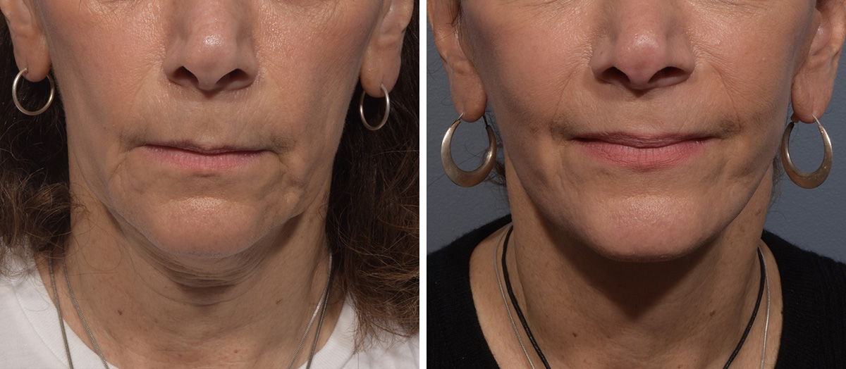 Neck Lift Before & After Gallery - Patient 150533 - Image 3