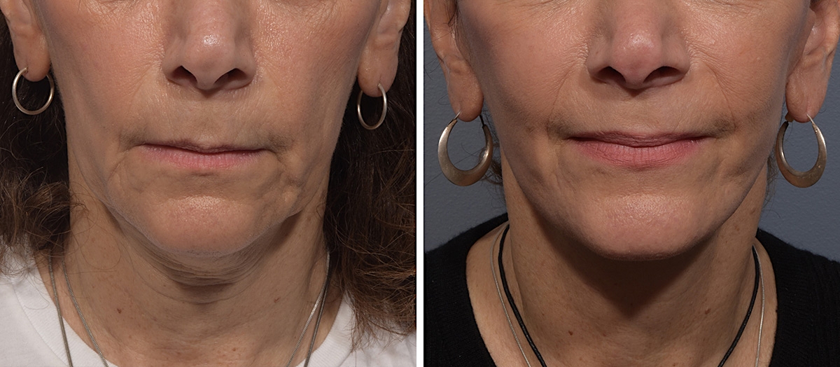 Neck Lift Before & After Gallery - Patient 150533 - Image 3