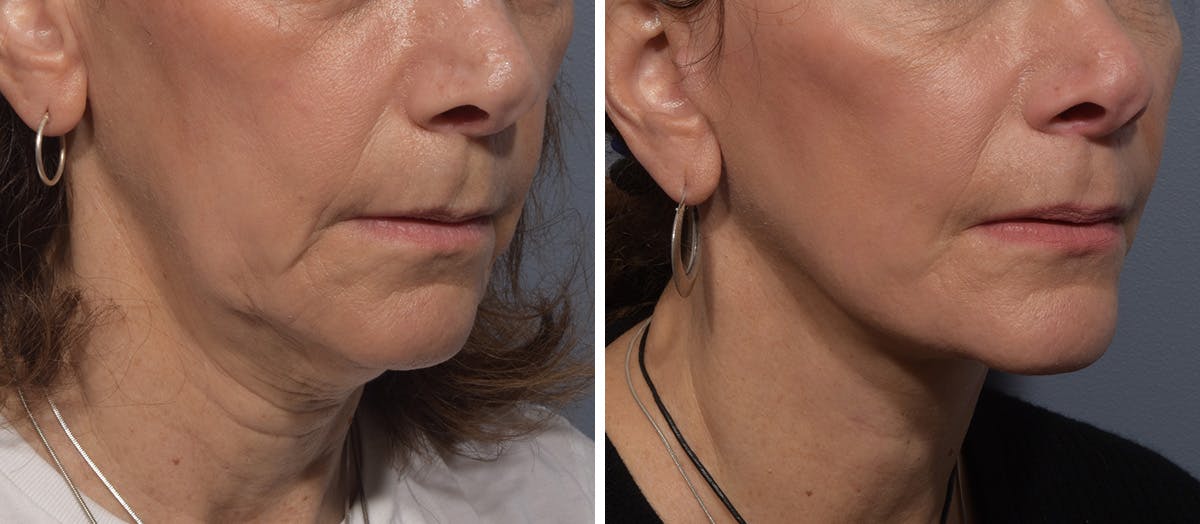 Neck Lift Before & After Gallery - Patient 150533 - Image 1