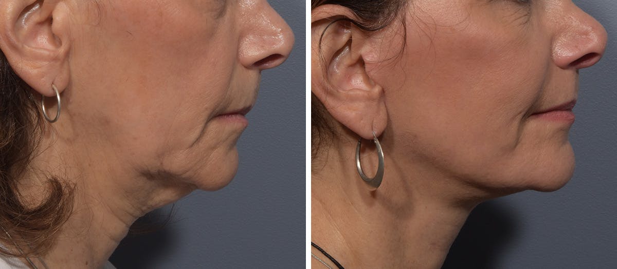 Neck Lift Before & After Gallery - Patient 150533 - Image 2