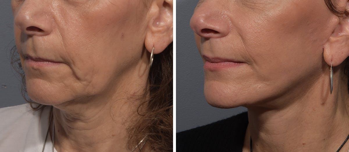 Neck Lift Before & After Gallery - Patient 150533 - Image 4