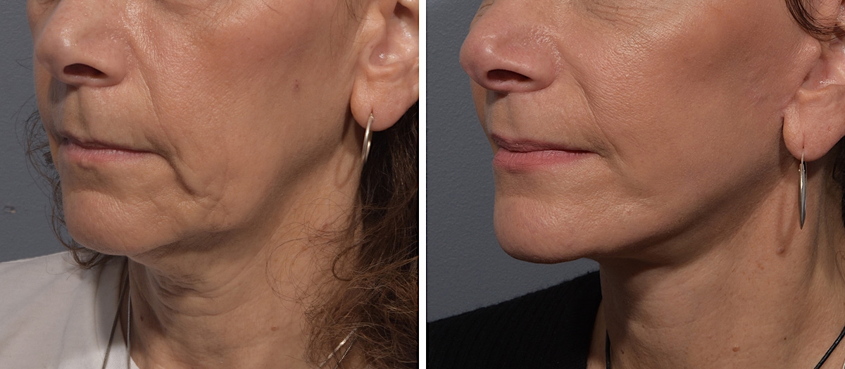 Neck Lift Before & After Gallery - Patient 150533 - Image 4