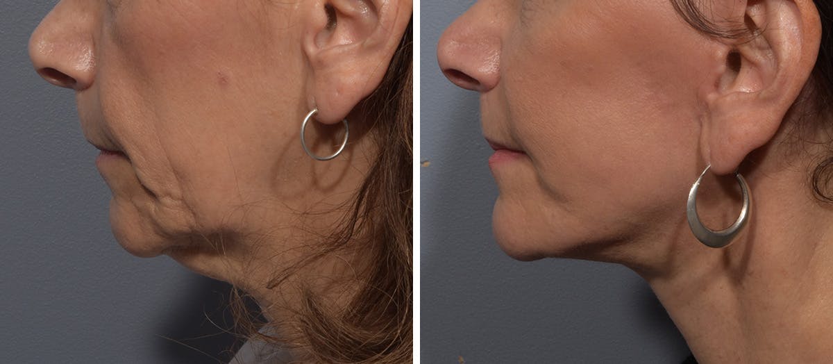 Neck Lift Before & After Gallery - Patient 150533 - Image 5