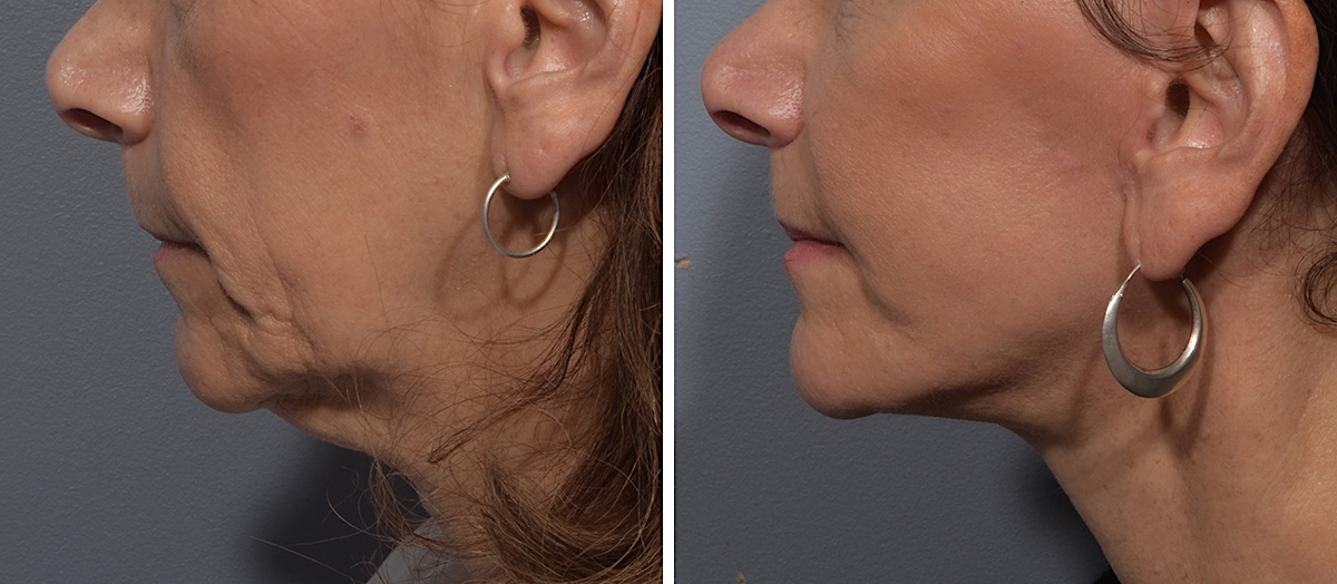 Neck Lift Before & After Gallery - Patient 150533 - Image 5