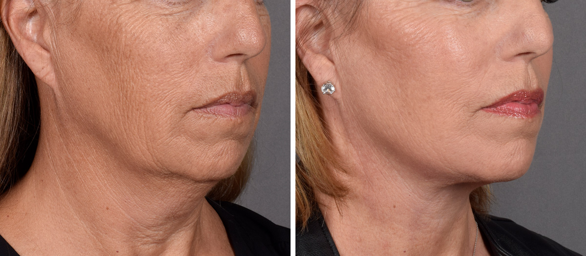 Neck Lift Before & After Gallery - Patient 439548 - Image 1