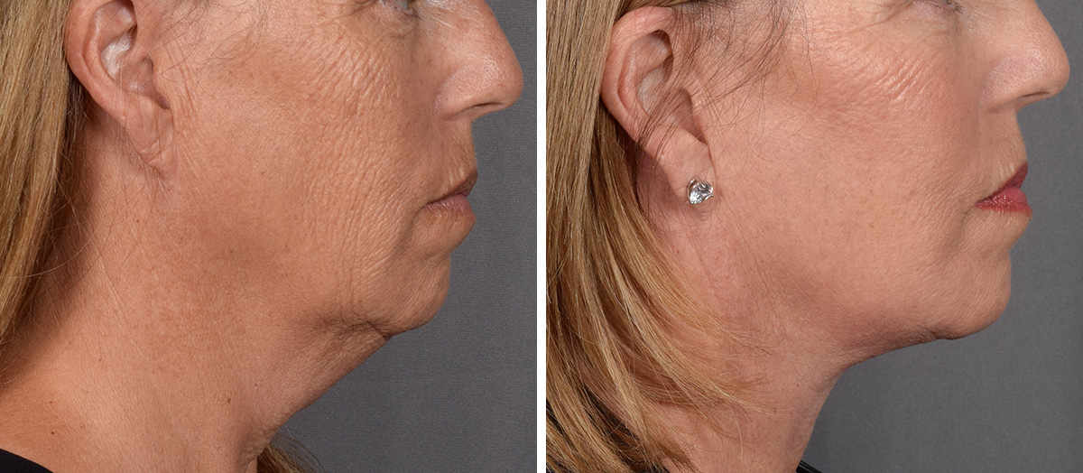Neck Lift Before & After Gallery - Patient 439548 - Image 2