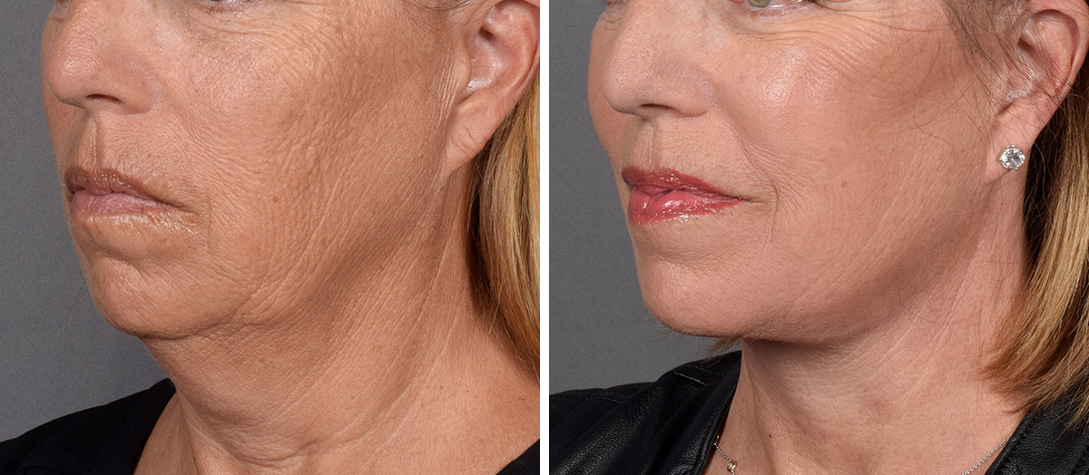 Neck Lift Before & After Gallery - Patient 439548 - Image 4