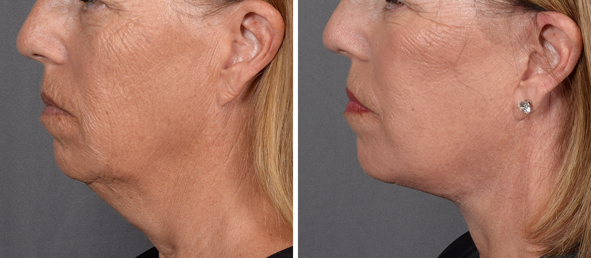 Neck Lift Before & After Gallery - Patient 439548 - Image 5