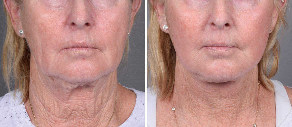 Neck Lift Before & After Gallery - Patient 358341 - Image 2