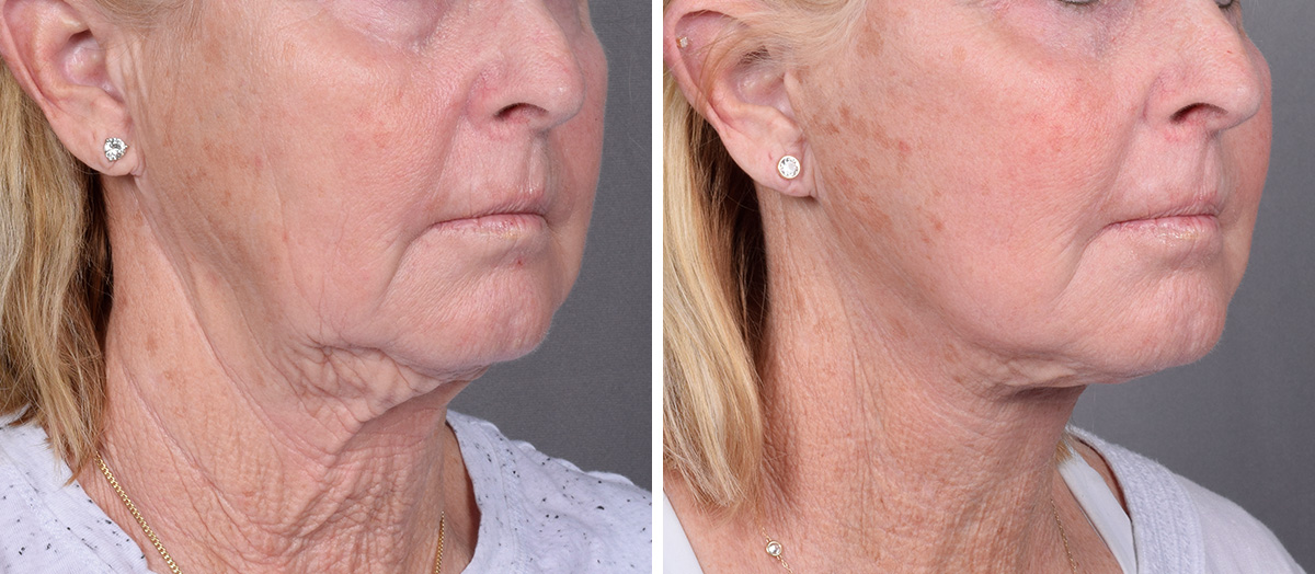 Neck Lift Before & After Gallery - Patient 358341 - Image 1
