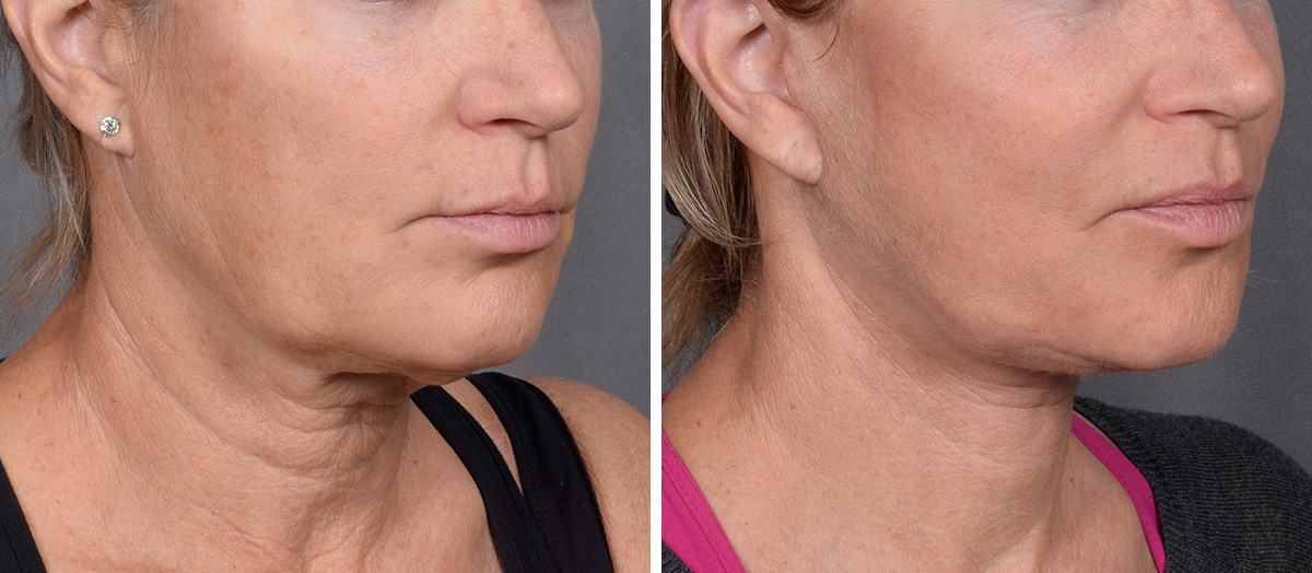 Neck Lift Before & After Gallery - Patient 773836 - Image 1