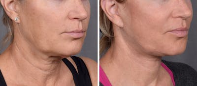 Neck Lift Before & After Gallery - Patient 773836 - Image 1