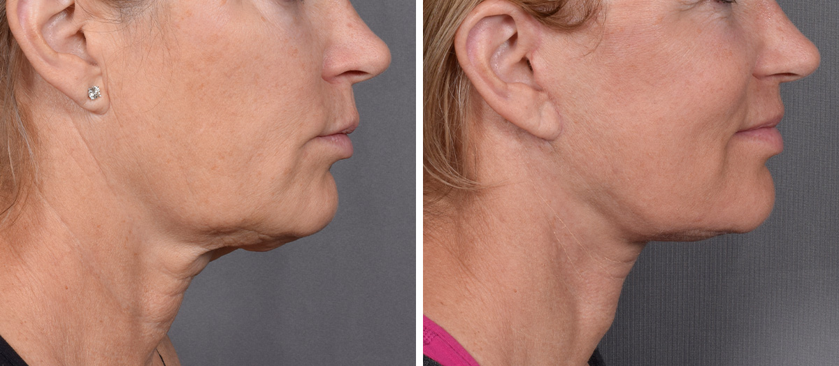 Neck Lift Before & After Gallery - Patient 773836 - Image 2