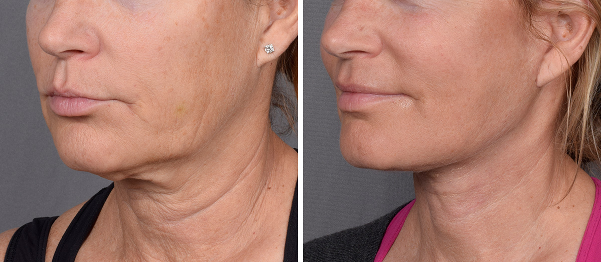 Neck Lift Before & After Gallery - Patient 773836 - Image 4