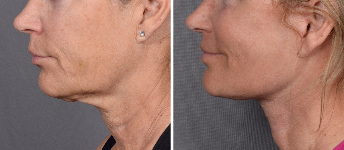 Neck Lift Before & After Gallery - Patient 773836 - Image 5