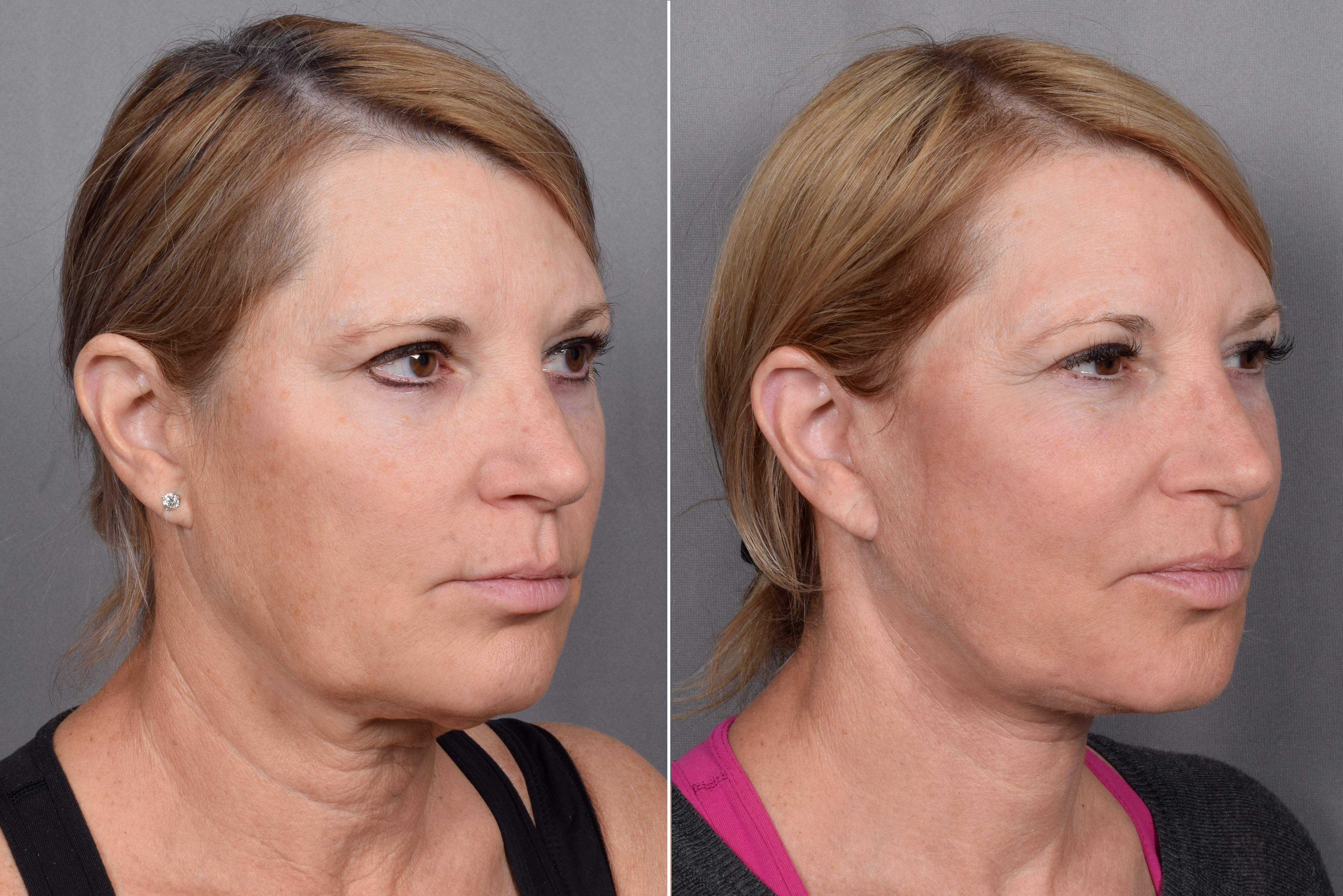 Neck Lift Before & After Gallery - Patient 773836 - Image 6