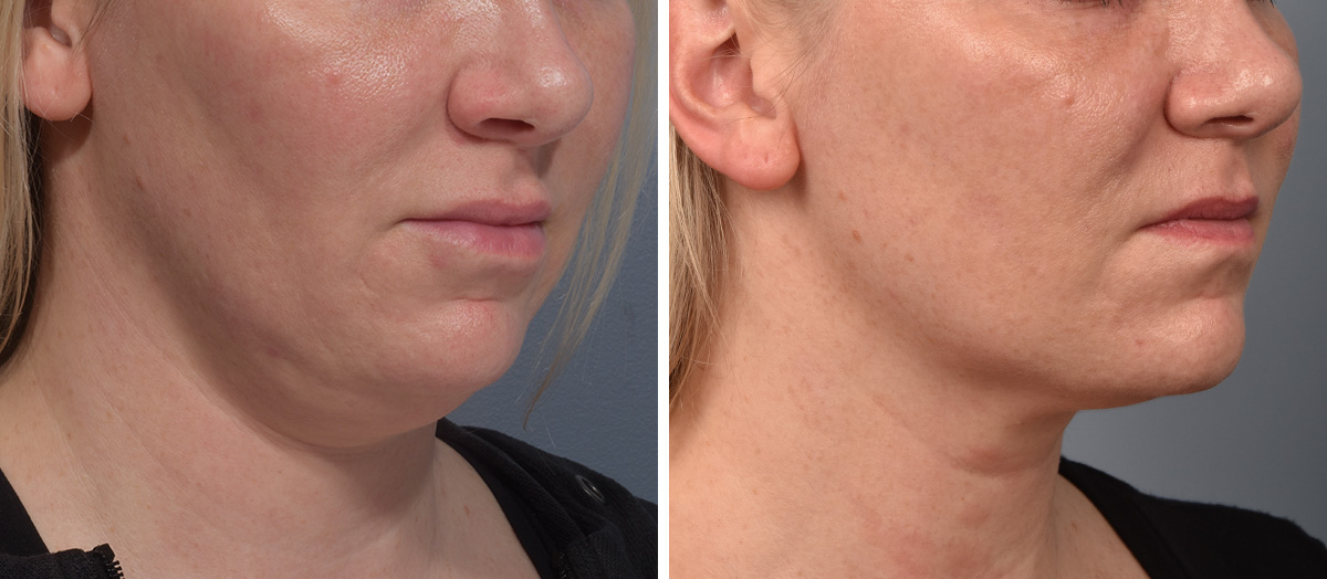 Neck Lift Before & After Gallery - Patient 709611 - Image 1