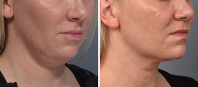 Neck Lift Before & After Gallery - Patient 709611 - Image 1