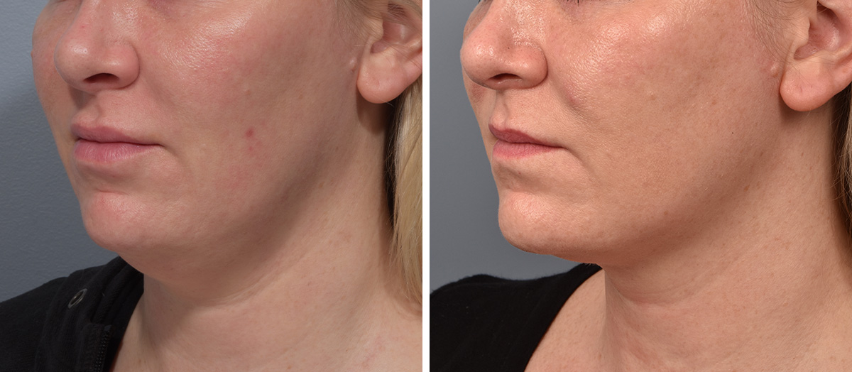 Neck Lift Before & After Gallery - Patient 709611 - Image 4