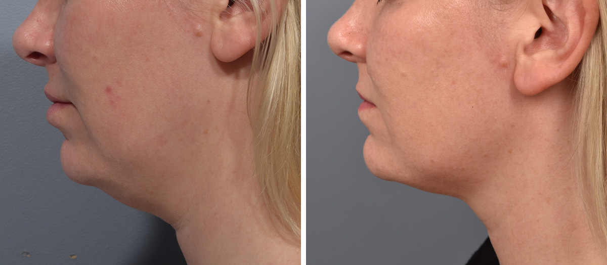 Neck Lift Before & After Gallery - Patient 709611 - Image 5