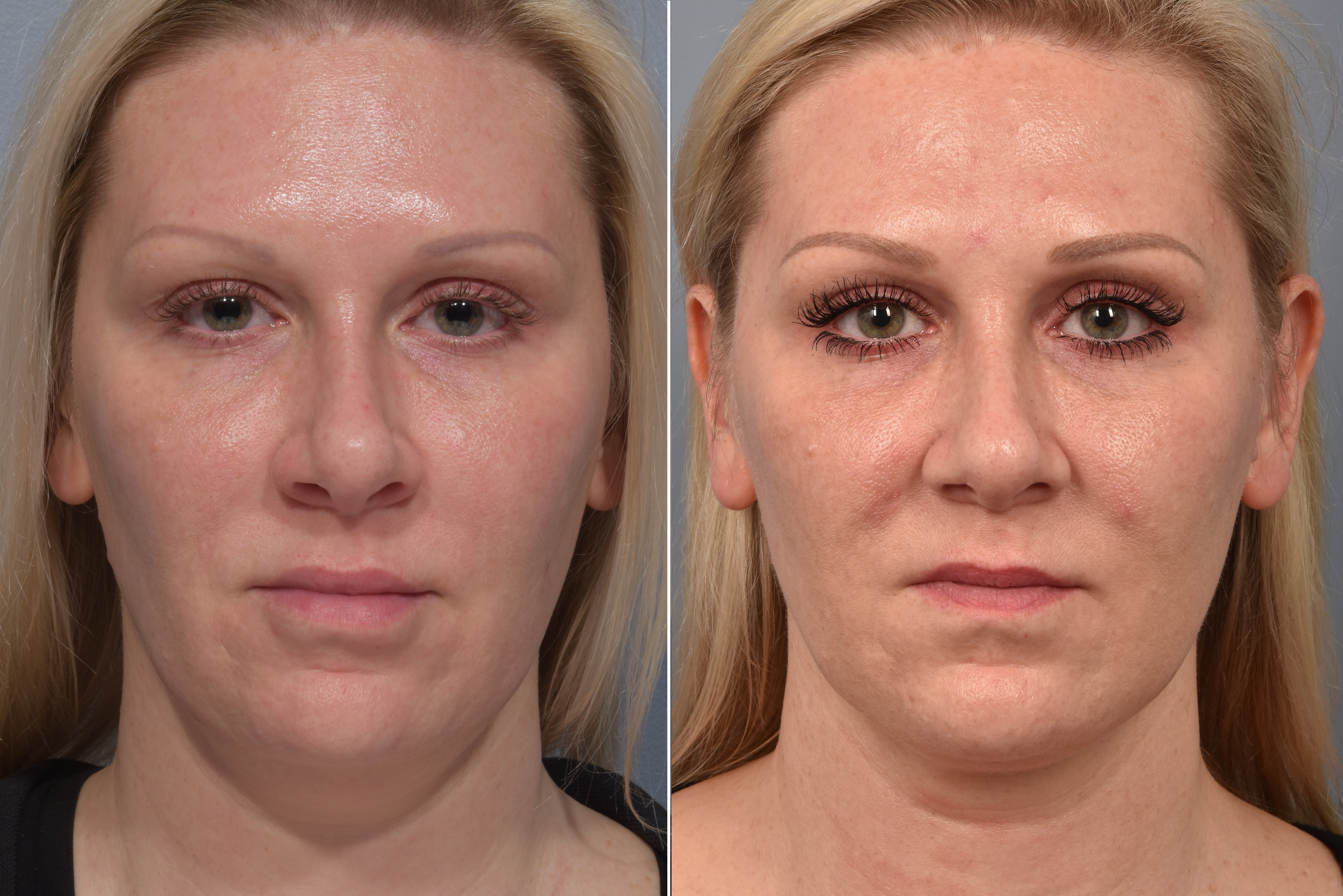 Neck Lift Before & After Gallery - Patient 709611 - Image 8